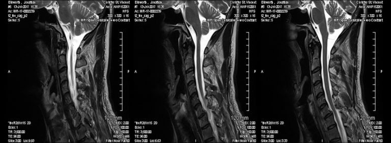 Blister Founder Jonathan Ellsworth's accident.